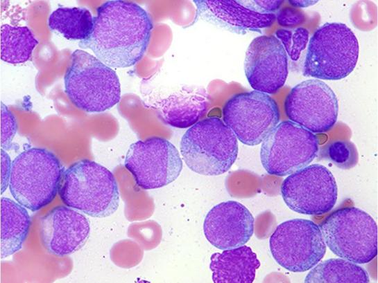 acute myeloïde leukemie