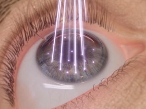 LASIK