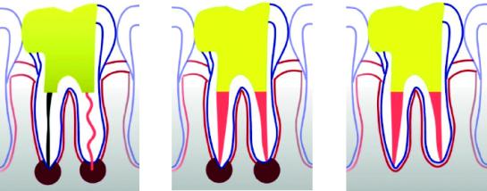 Tand voor een endodontische herbehandeling (links), meteen na herbehandeling (midden) en na genezing (rechts)